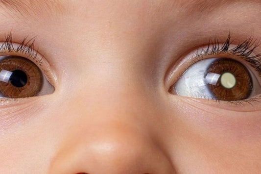 Entenda o que é retinoblastoma e aprenda a notar os possíveis sinais deste terrível problema - SunKids