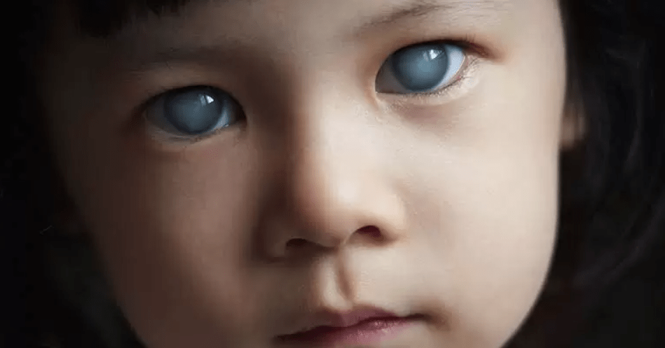 Glaucoma infantil: O que é e como identificar - SunKids