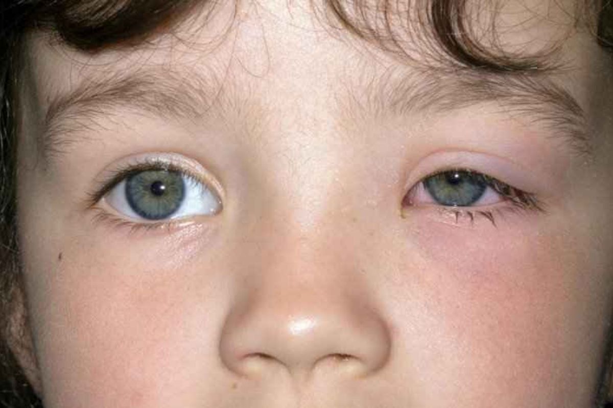 Conheça as principais causas e tratamentos para o globo ocular inchado em crianças - SunKids