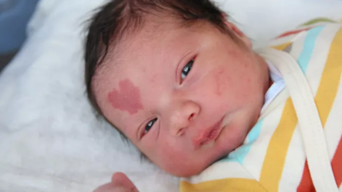 Marca de nascença do meu bebê: Quando pode ser perigosa?