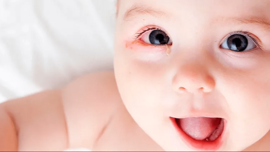 Coceira nos olhos do bebê: o que pode ser? - SunKids