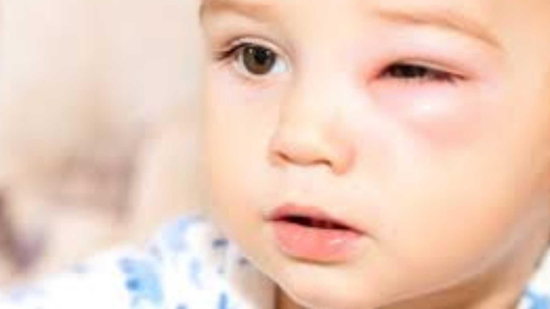 Criança com alergia nos olhos:  causas, sintomas, tratamento e como evitar