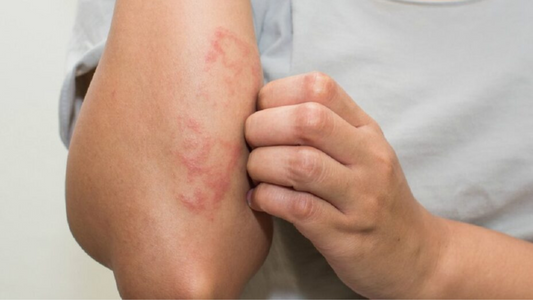 Dermatite atópica em crianças: Tudo que você precisa saber