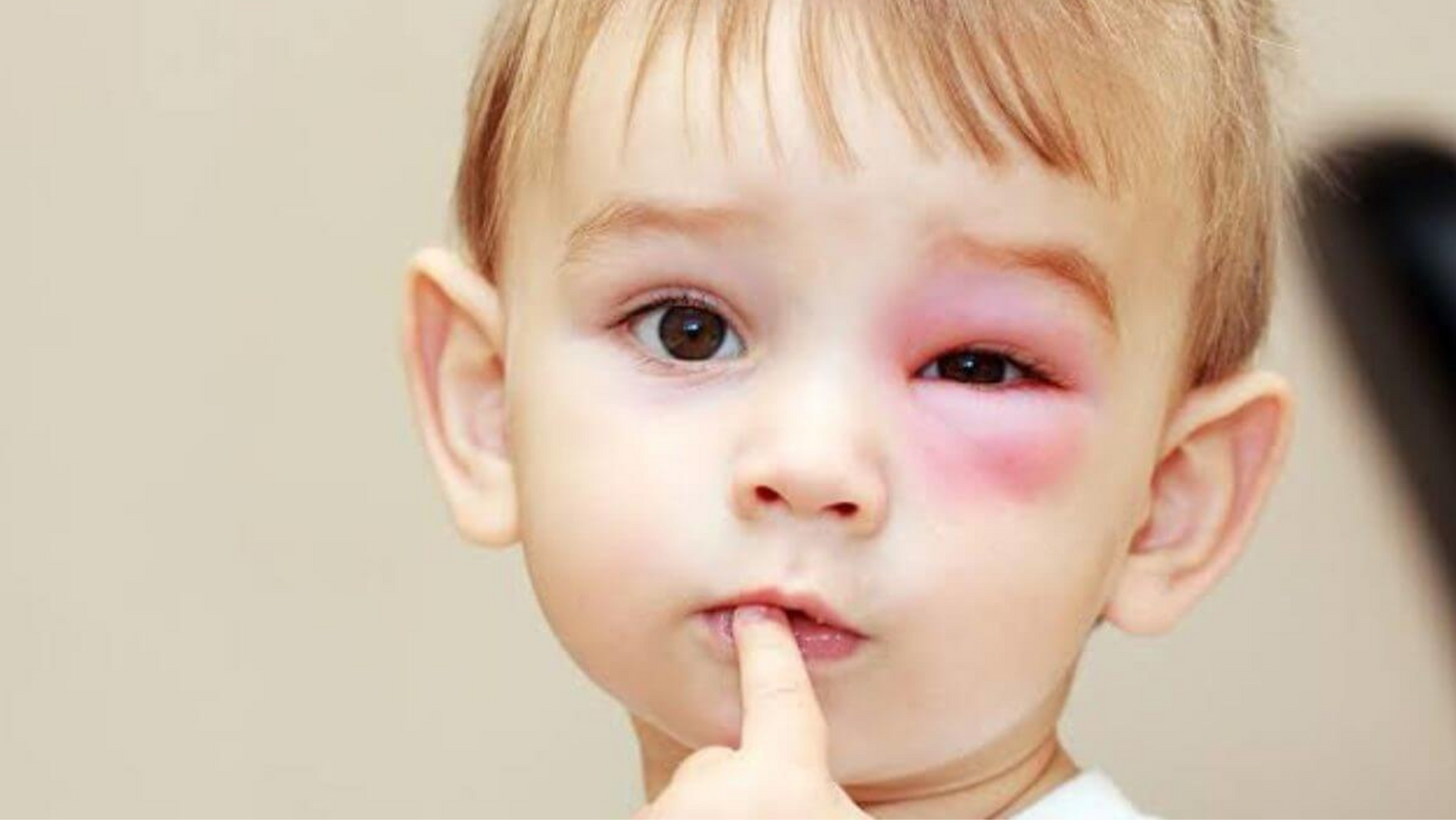 Seu filho machucou o olho? Confira os primeiros socorros essenciais!